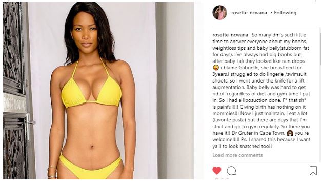 Rossette Ncwana - Breast Implants and Tummy Tuck