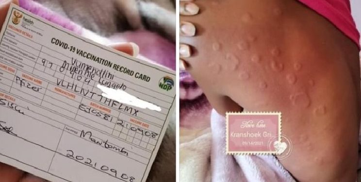 Pictures: 24-year-old develops rare skin disease after being vaccinated