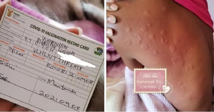 Pictures: 24-year-old develops rare skin disease after being vaccinated