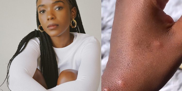 Ama Qamata monkeypox