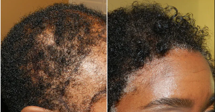 Hair transplant